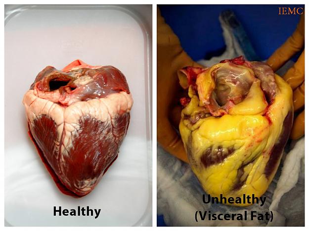 Click to Enlarge

Name: Normal-VS-Fatty-Heart_Fotor1.jpg
Size: 432 KB