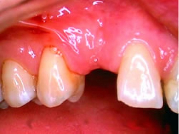 Click to Enlarge

Name: tooth gap 2.jpg
Size: 45 KB